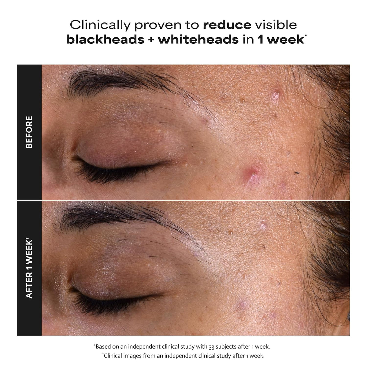 Paula's Choice 2% BHA Liquid Peeling, Bekämpft Mitesser und Poren, 118 ml
